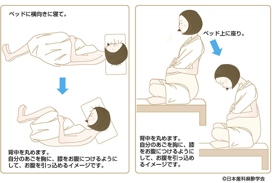 無痛分娩